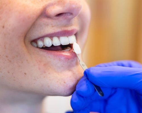 Dentisterie esthétique Dentisterie esthétique